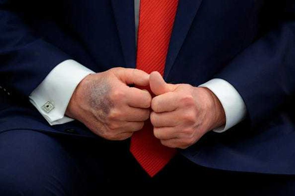 A bruise is visible on the back of U.S. President Donald Trump