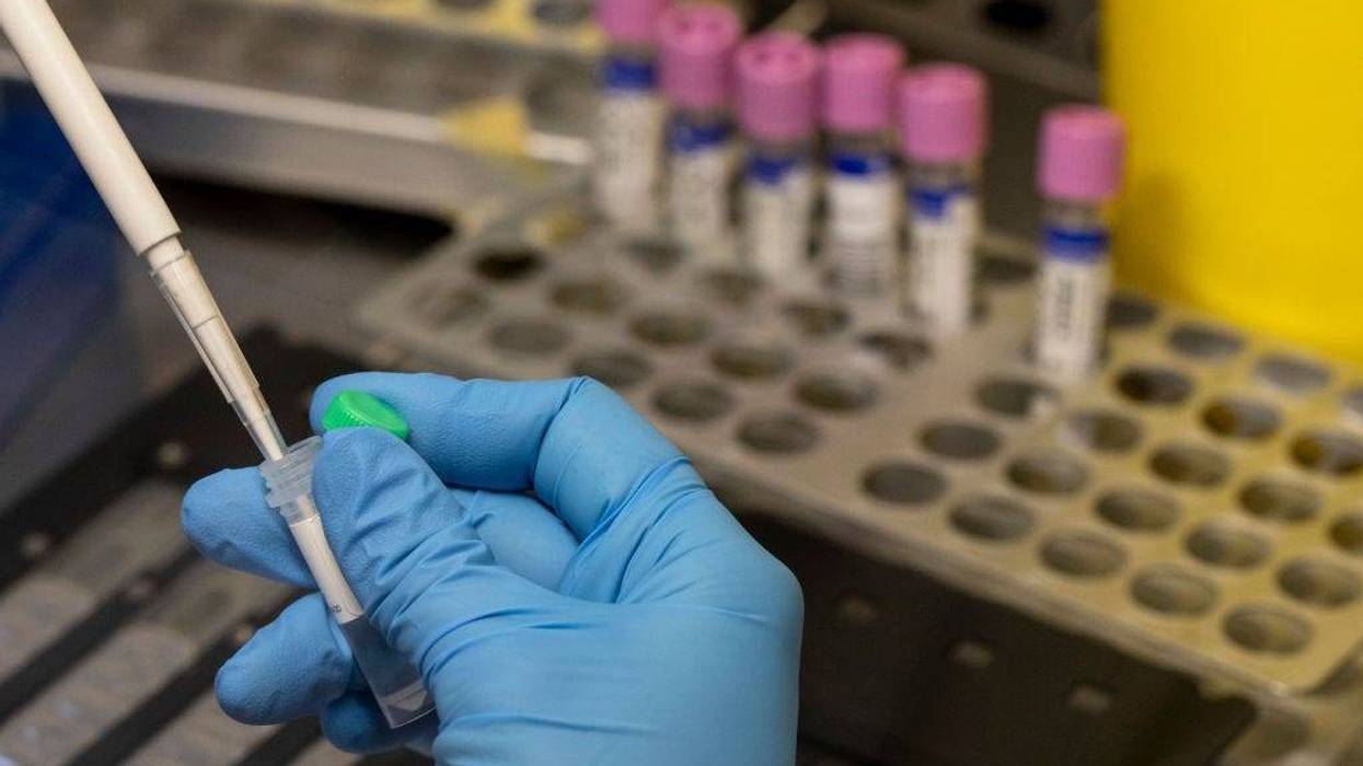 A medical laboratory technician inactivates suspected monkeypox samples to be PCR tested at the microbiology laboratory of La Paz Hospital on June 06, 2022 in Madrid, Spain.