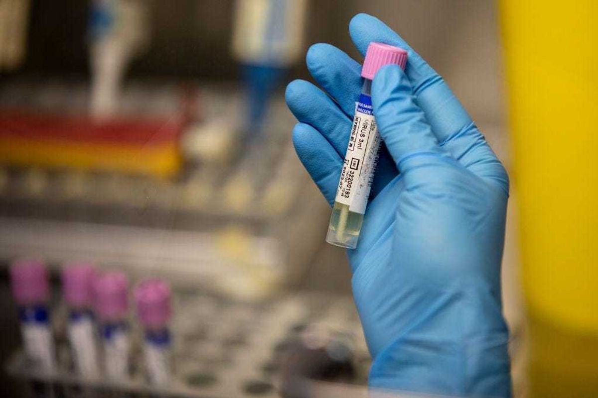 A medical laboratory technician shows a suspected monkeypox sample at the microbiology laboratory of La Paz Hospital on June 06, 2022 in Madrid, Spain.