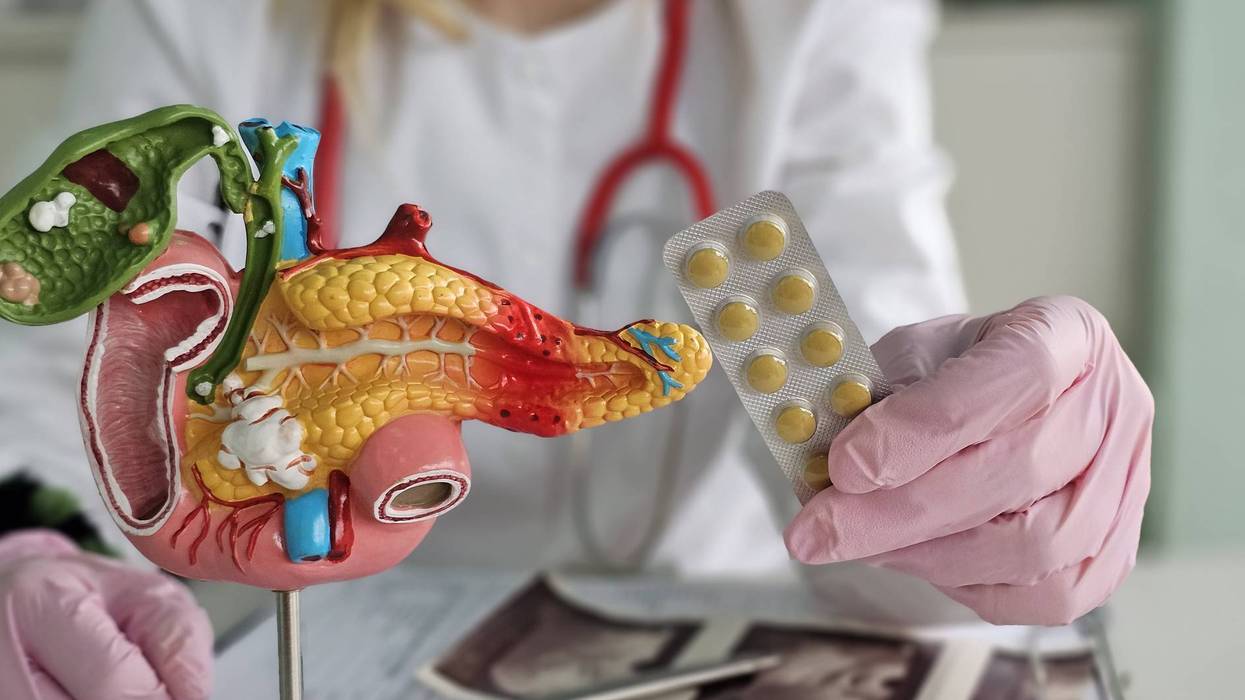 A new drug to treat pancreatic cancer is a "game-changer," and expected to be available in Minnesota soon