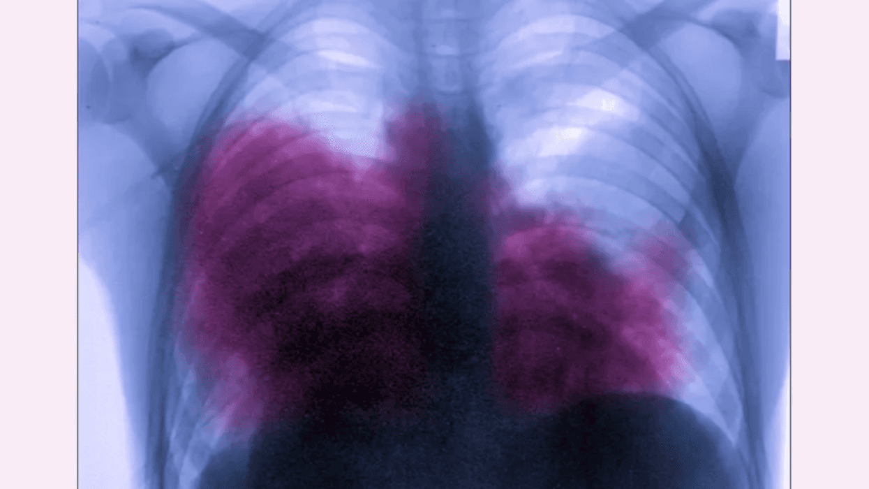 Acute bilateral pneumonia (legionnaires disease caused by Legionella pneumophila), seen on a frontal chest x-ray.
