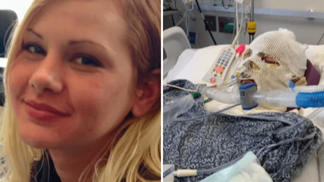 Alyssa Morales suffered severe burns after being set on fire.