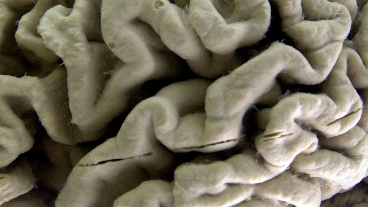 ALZHEIMER-ANÁLISIS DE SANGRE