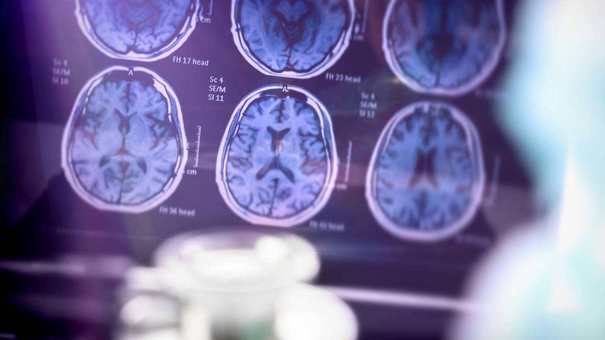 Alzheimer's disease