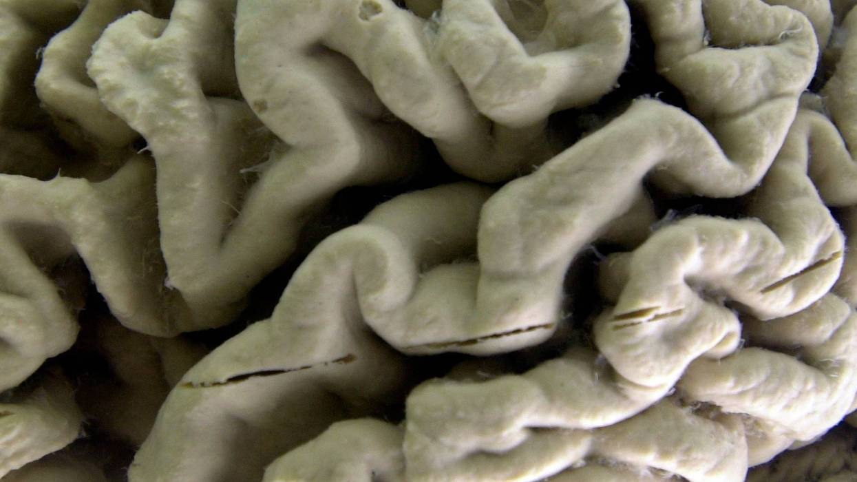 Alzheimers-Blood Test