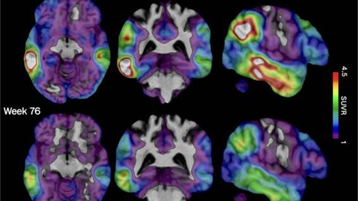 Alzheimers New Experimental Drugs 311