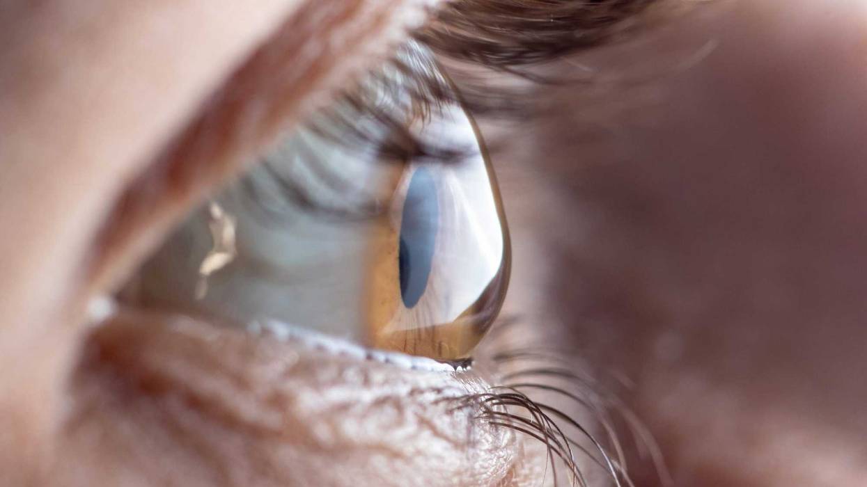 An eye with keratoconus, a condition where cornea tissue thins and bulges outward, leading to vision problems.