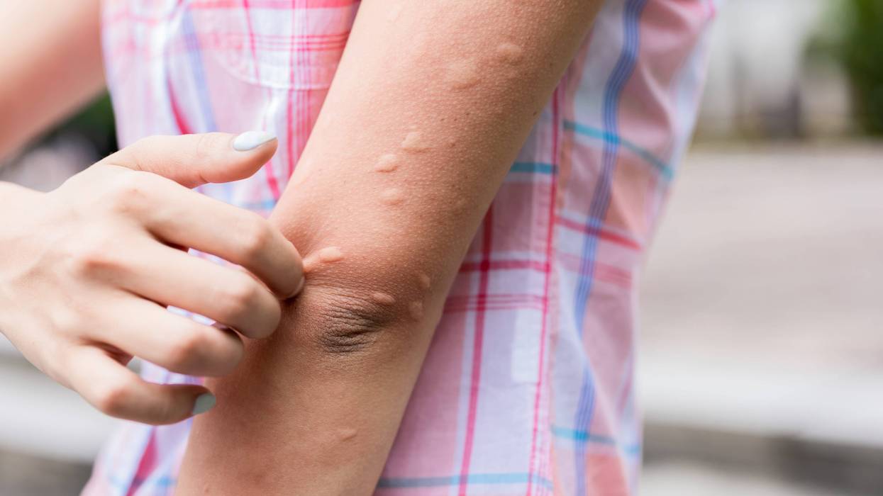 Are you a mosquito magnet? It could be your smell