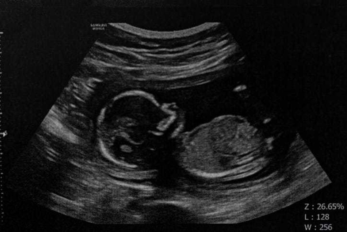 baby sonogram