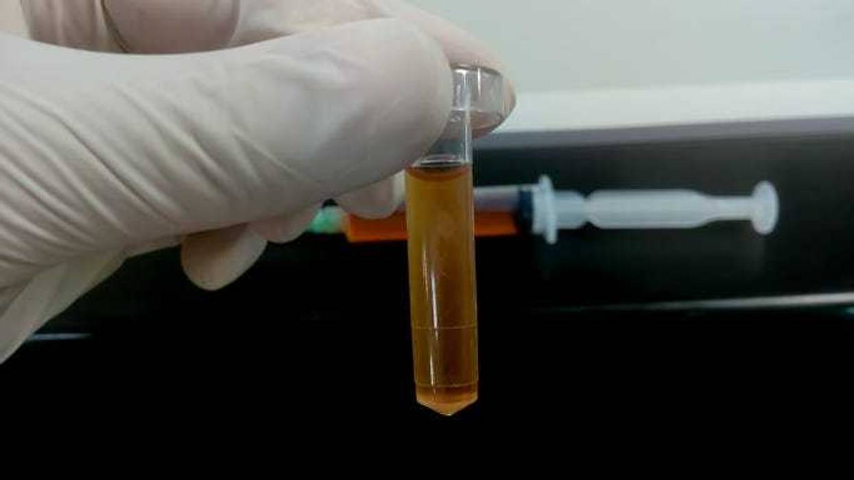 Biochemist holding a Cerebrospinal fluid (CSF) sample.