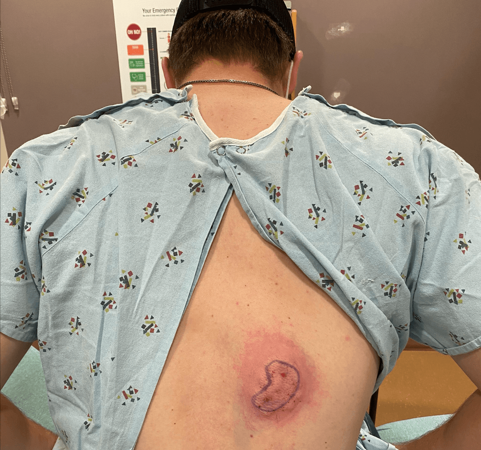 bite on back from bear