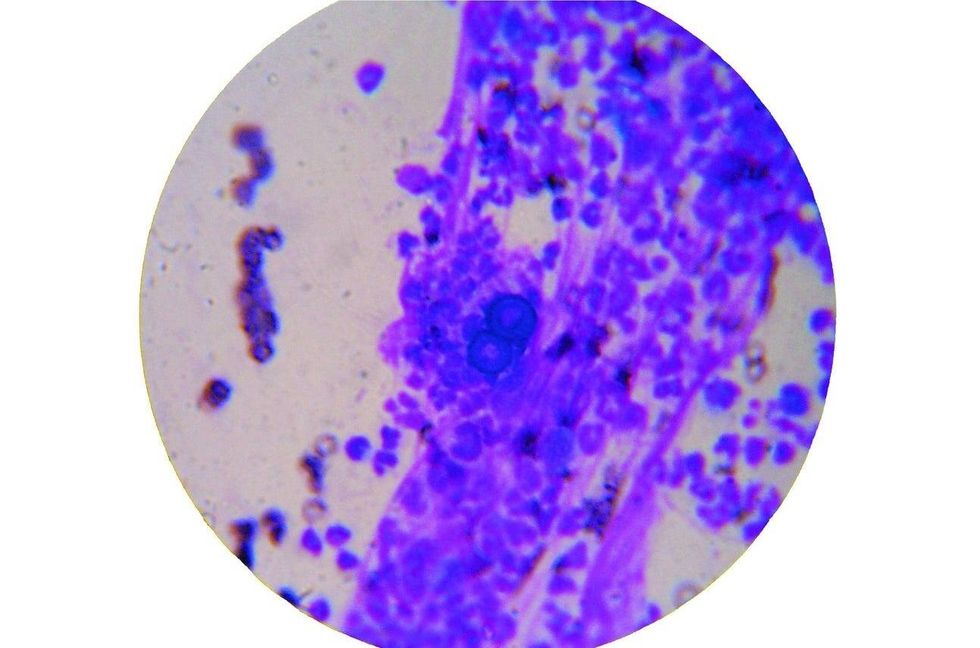 Blastomycosis is a fungal infection that often has flu-like symptoms.