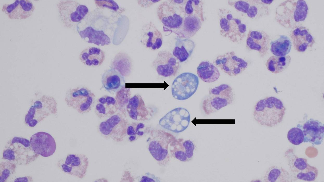 CDC Naegleria fowleri