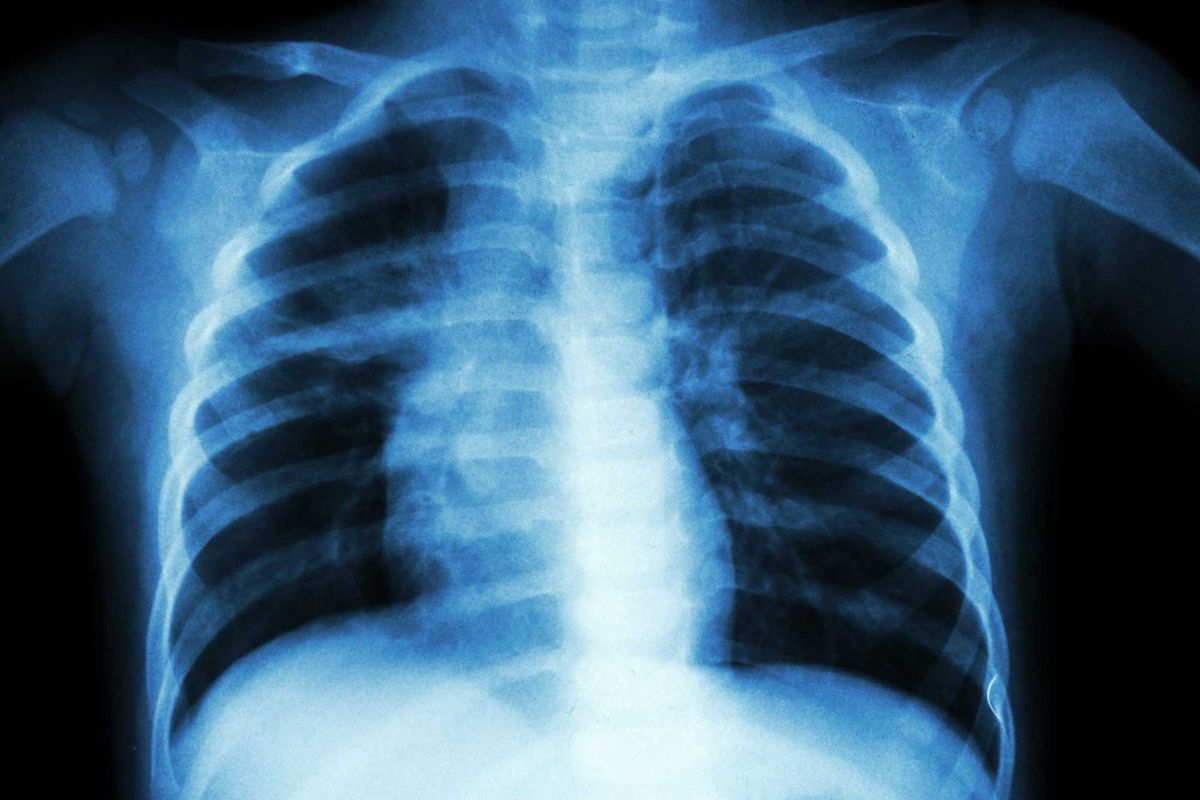 Child lung x-ray