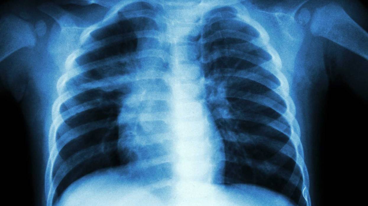 Child lung x-ray