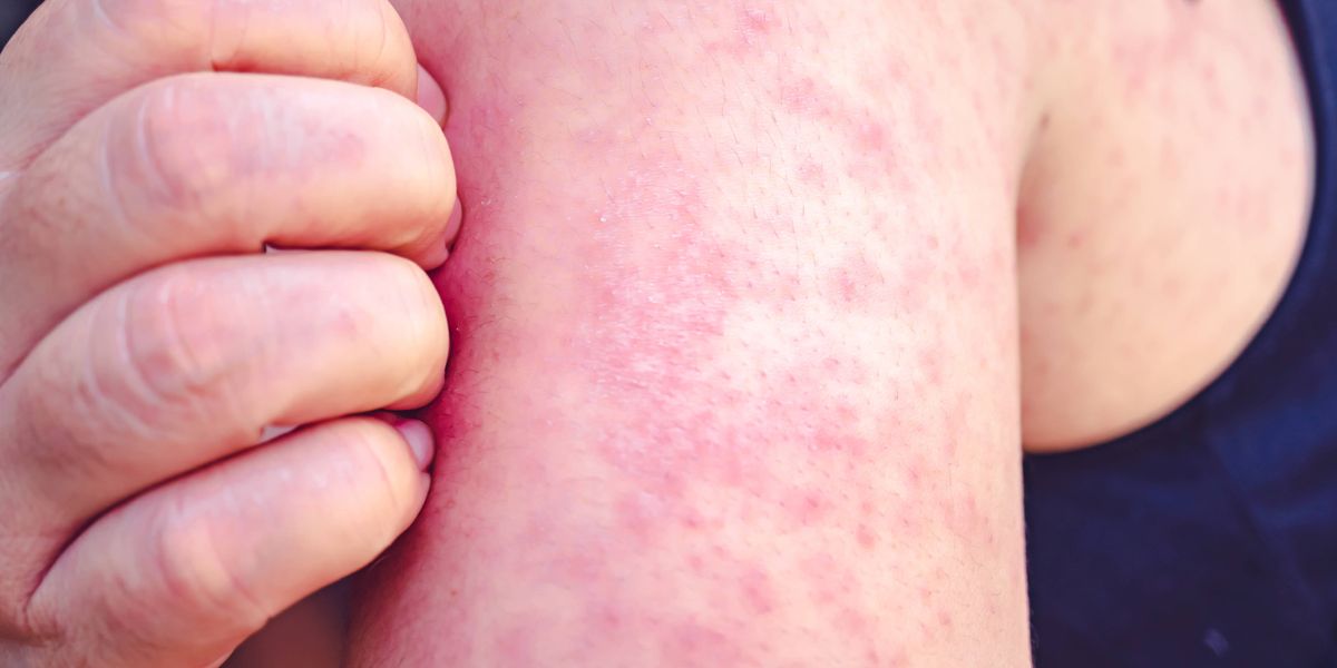 Delaware County officials urge caution, vaccination after measles is found in wastewater samples