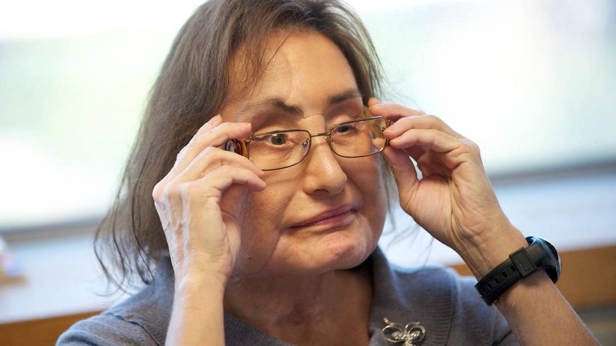 Connie Culp, who underwent the first face transplant surgery in the U.S. in 2008, talks with the Associated Press at the Cleveland Clinic on Sept. 14, 2010. AP PHOTO/JASON MILLER