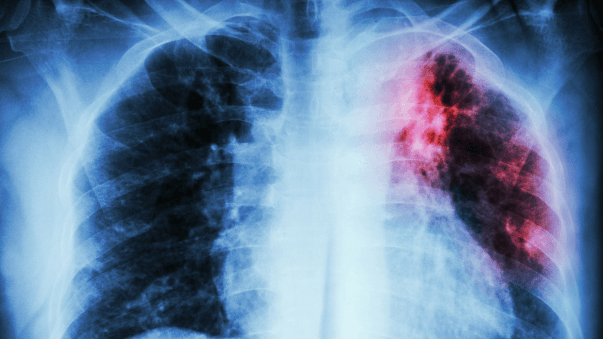 Dallas County Health and Human Services is investigating a possible tuberculosis exposure at MacArthur High School in Irving that occurred during the 2025-26 school year, according to the agency and Irving ISD.