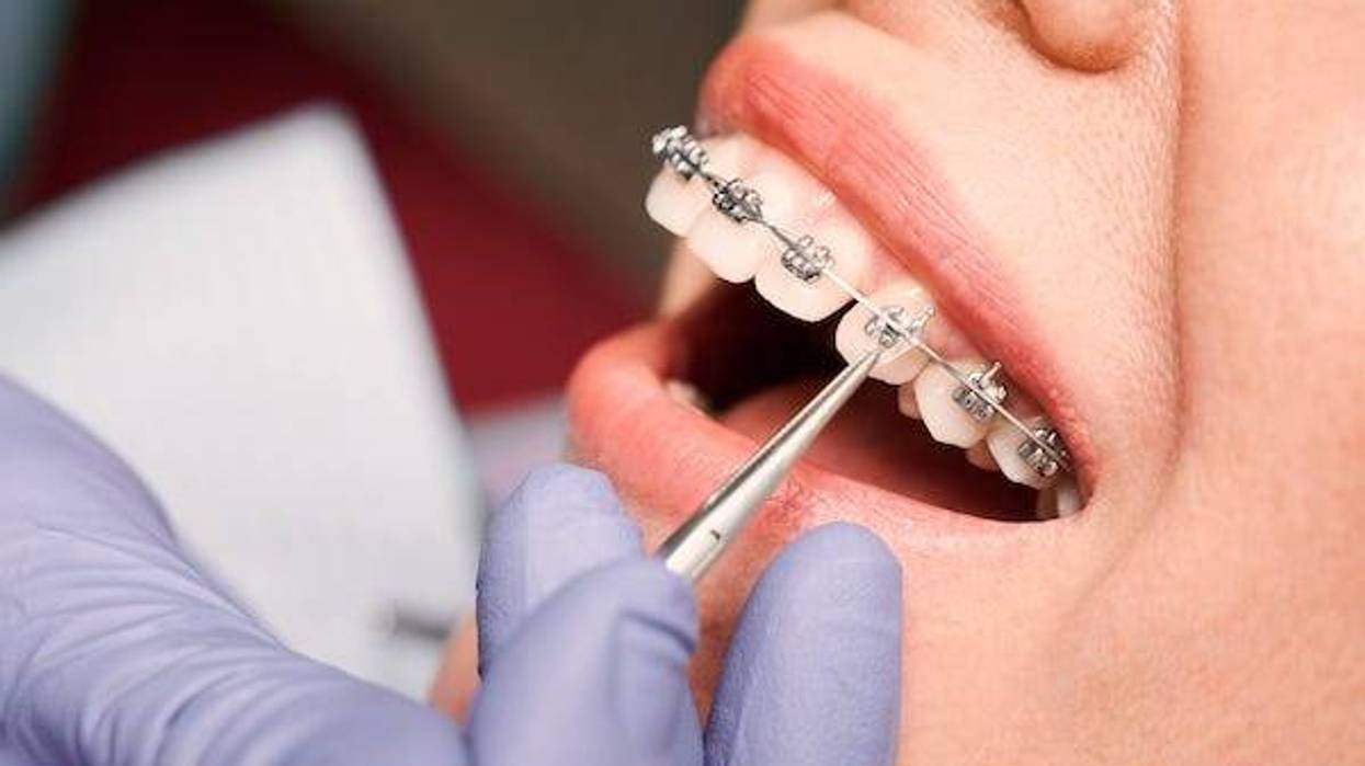 Dentist applying rubber bands to braces