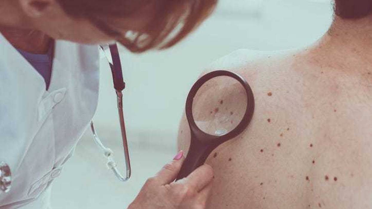 Doctor examining a patients skin for melanoma.