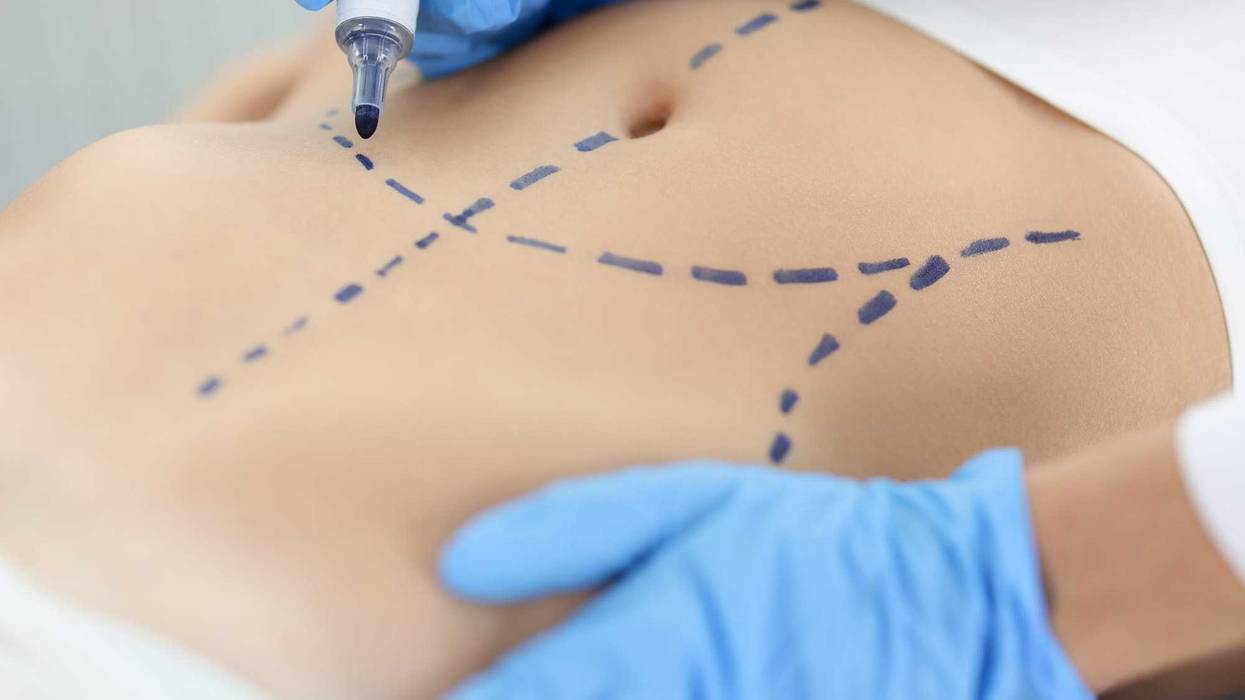 Doctor plastic surgeon drawing preoperative markings on skin of patient abdomen closeup. Plastic surgery and aesthetic medicine liposuction concept
