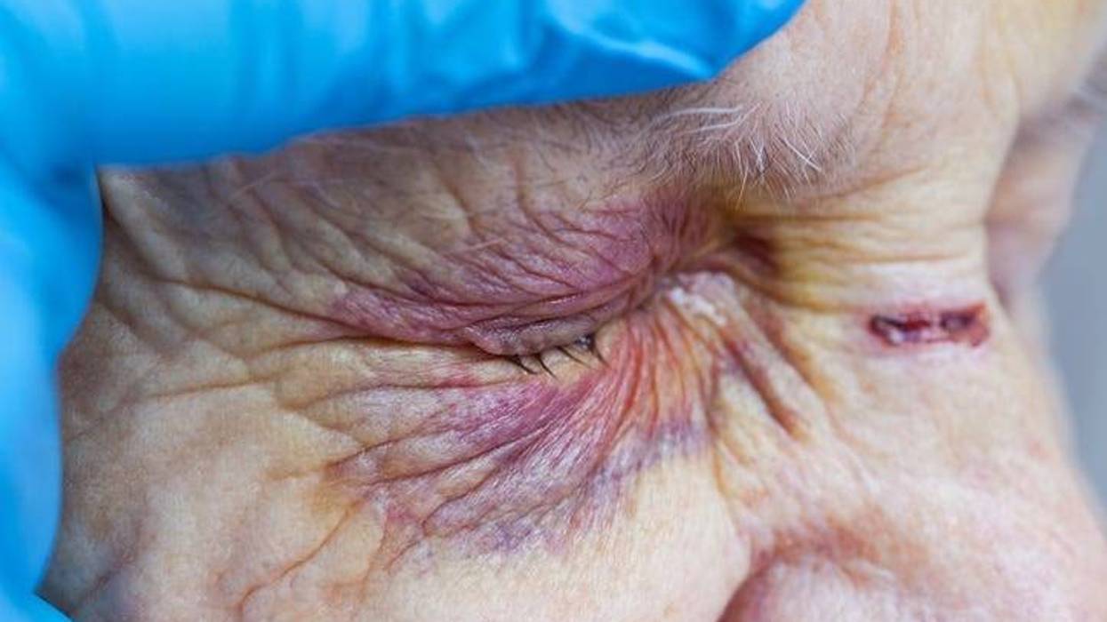Elderly woman's injured eye & nurse's fingers