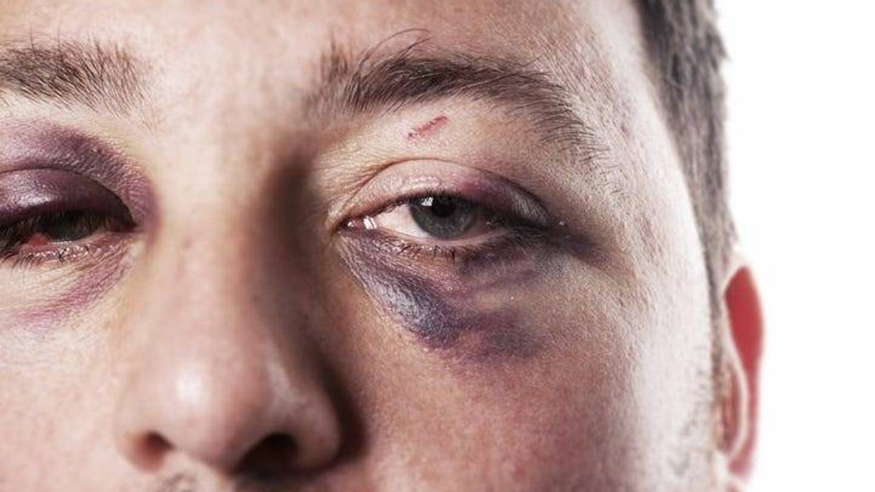 eye injury, male with black eye isolated on white. man after accident or fight with bruise