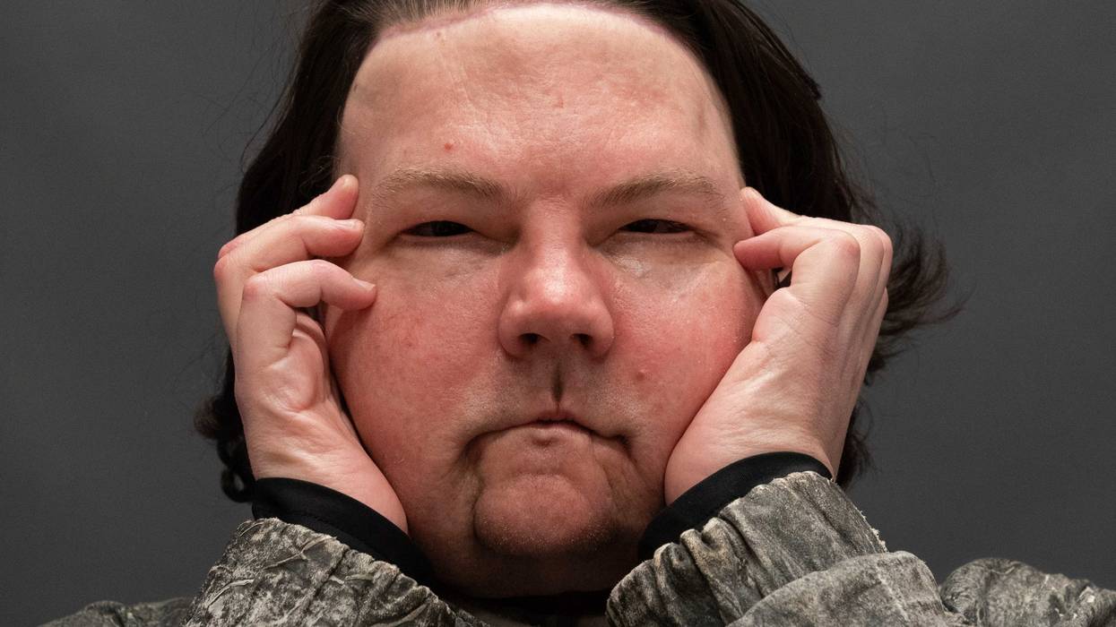 Face Double Hand Transplant