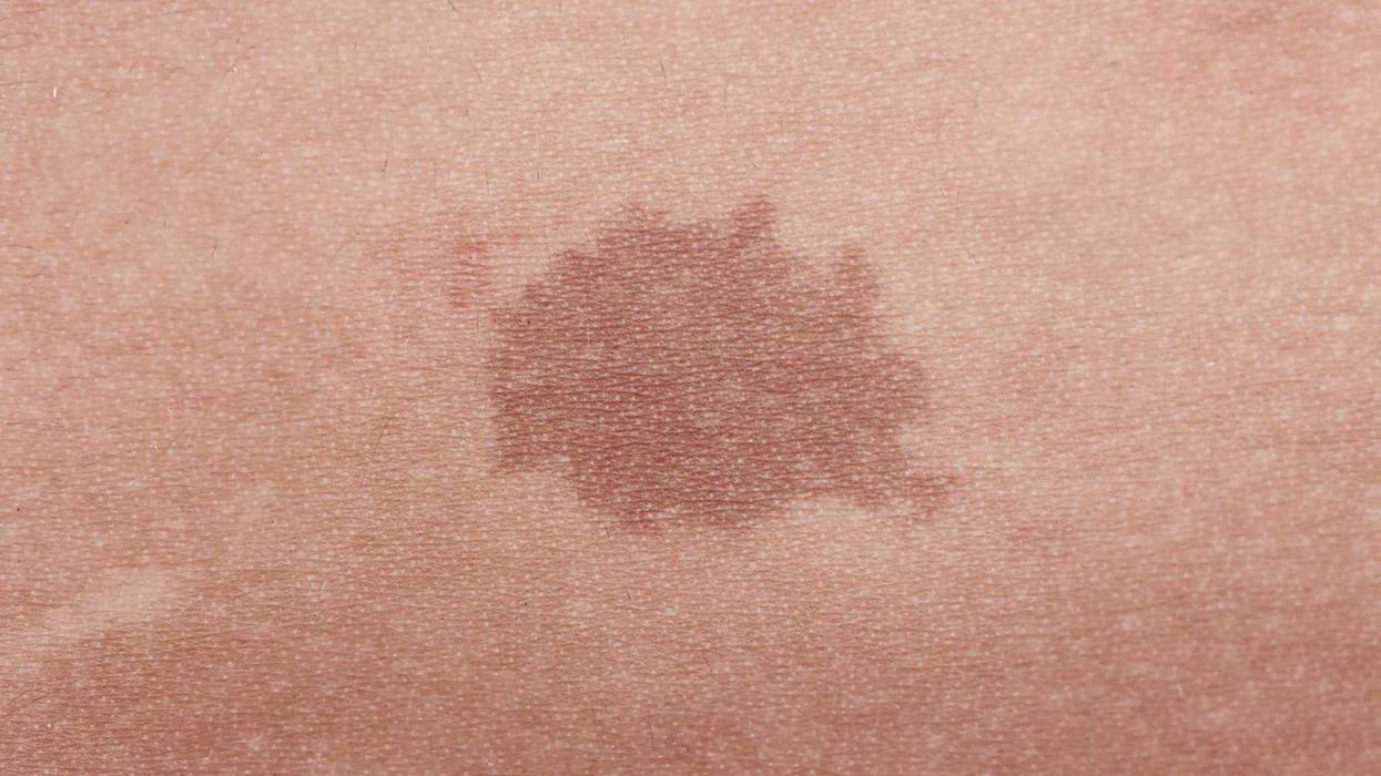 Flat, light brown birthmark.