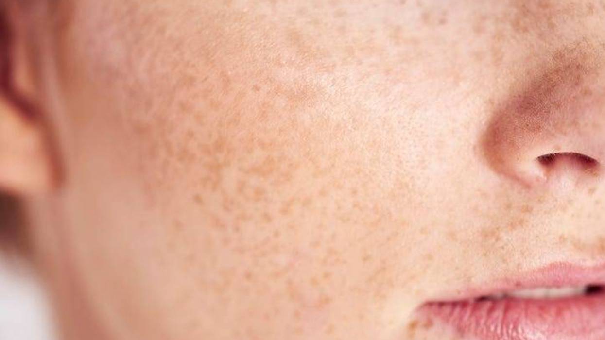 Freckles