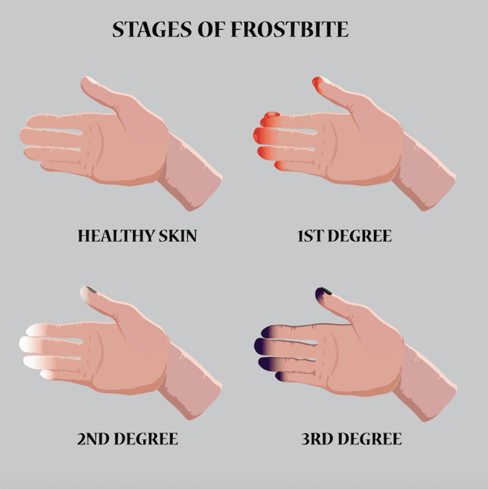 frostbite chart