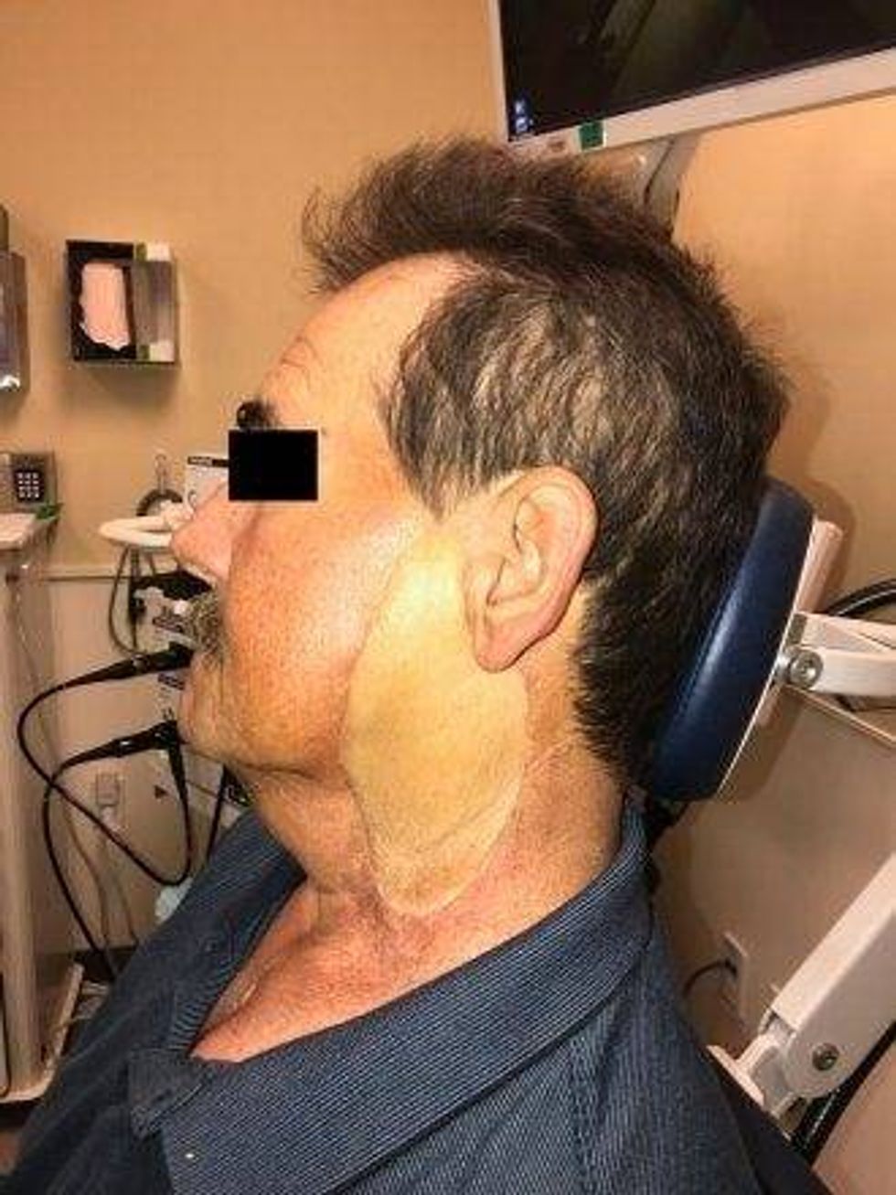 Grafting skin from the thigh is typically used in facial reconstruction but may result in poor color match.