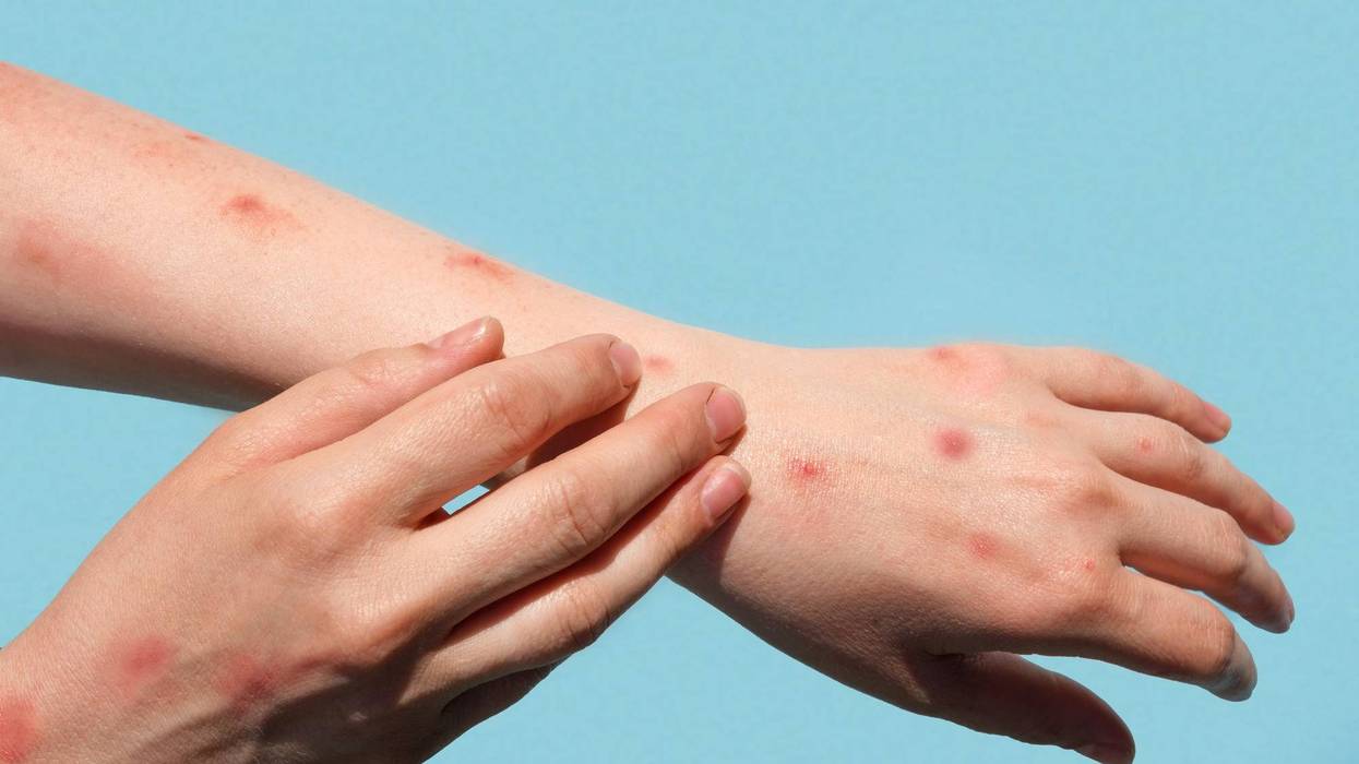 Health officials have identified another possible case of Monkeypox in Michigan on Friday, brining the total number of probable or confirmed cases of the virus up to three.