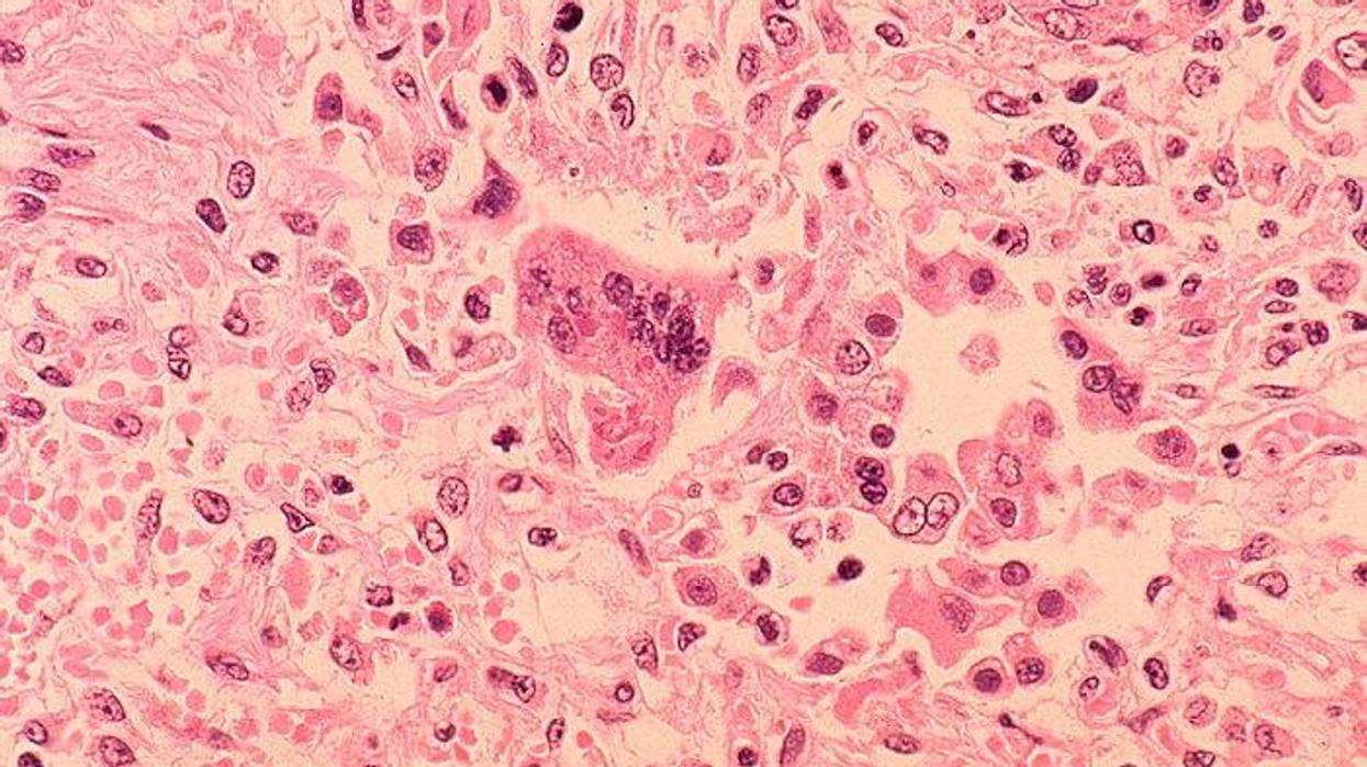 histopathology of measles pneumonia is seen in this microscope image