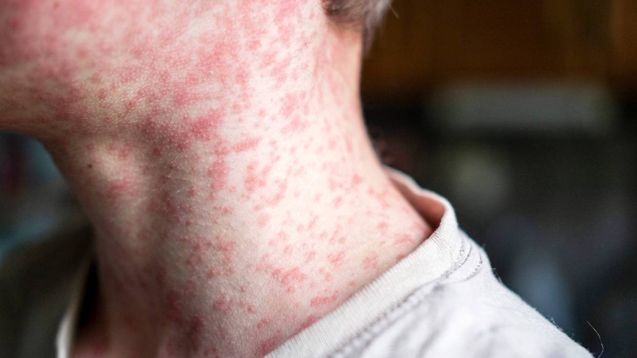 Human skin covered with measles rash