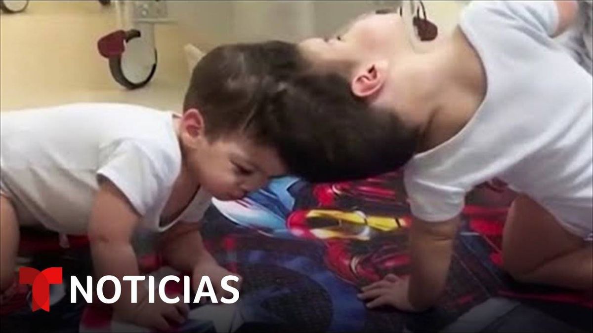 Medicos En Brasil Separan A Siameses Unidos Por La Cabeza