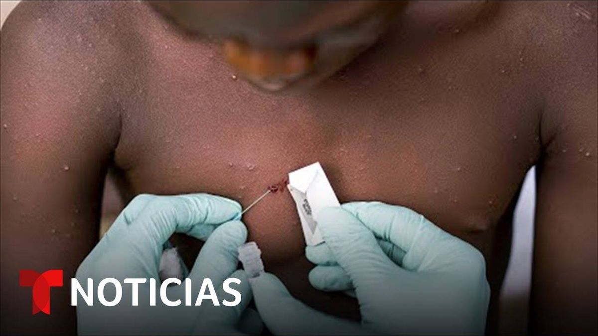 Consejos Para Prevenir Contagio De La Viruela Del Mono