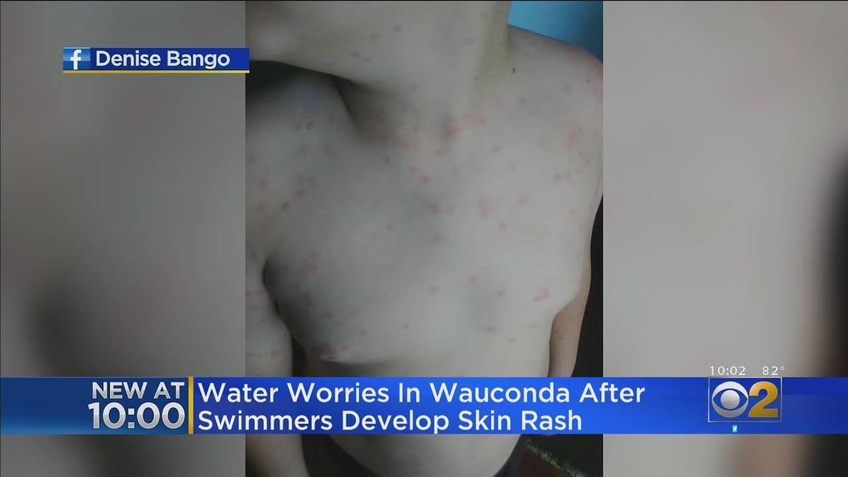 At least 12 kids develop rash after swimming in lake at Phil's Beach; Wauconda residents want answers