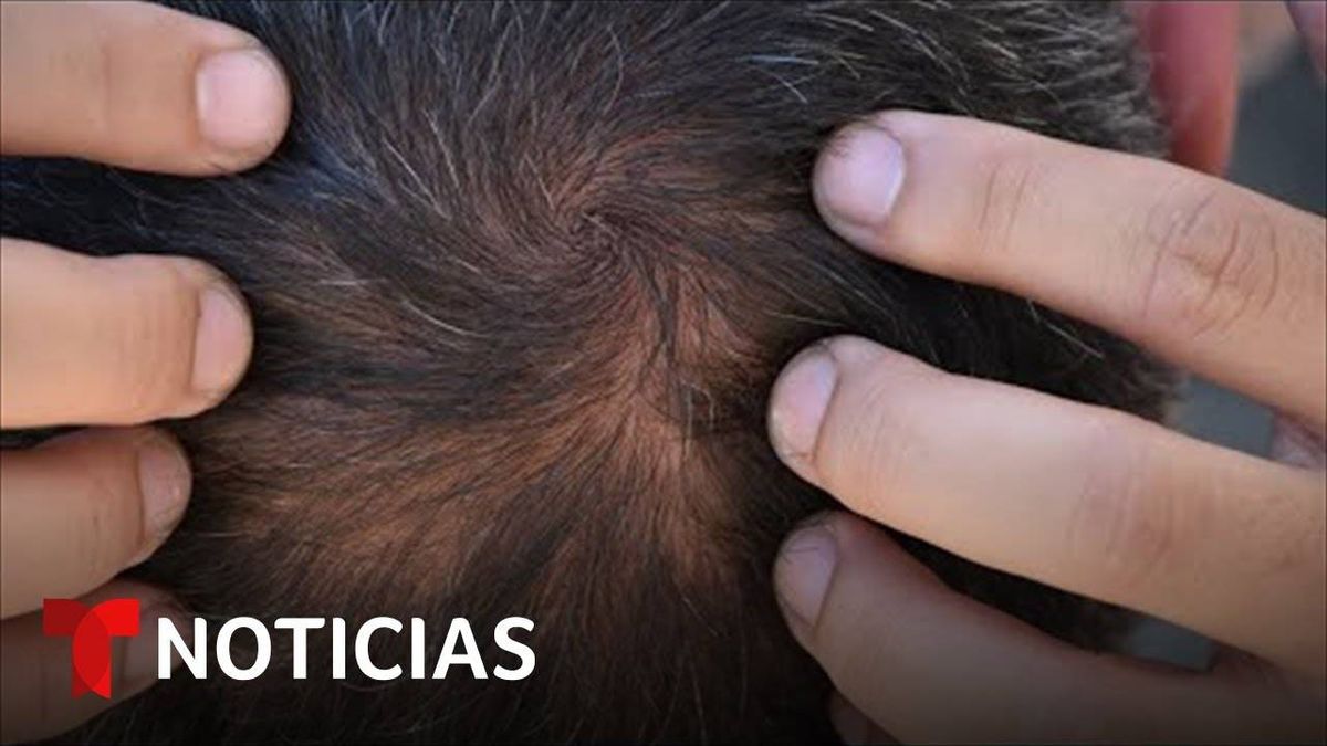 LA FDA Aprueba Medicamento Contra La Calvicie