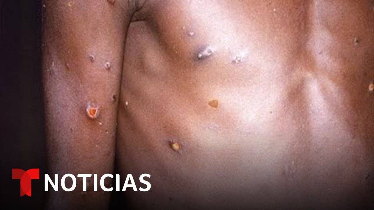Autoridades En Salud Investigan Un Posible Tercer Caso De Viruela Del Mono