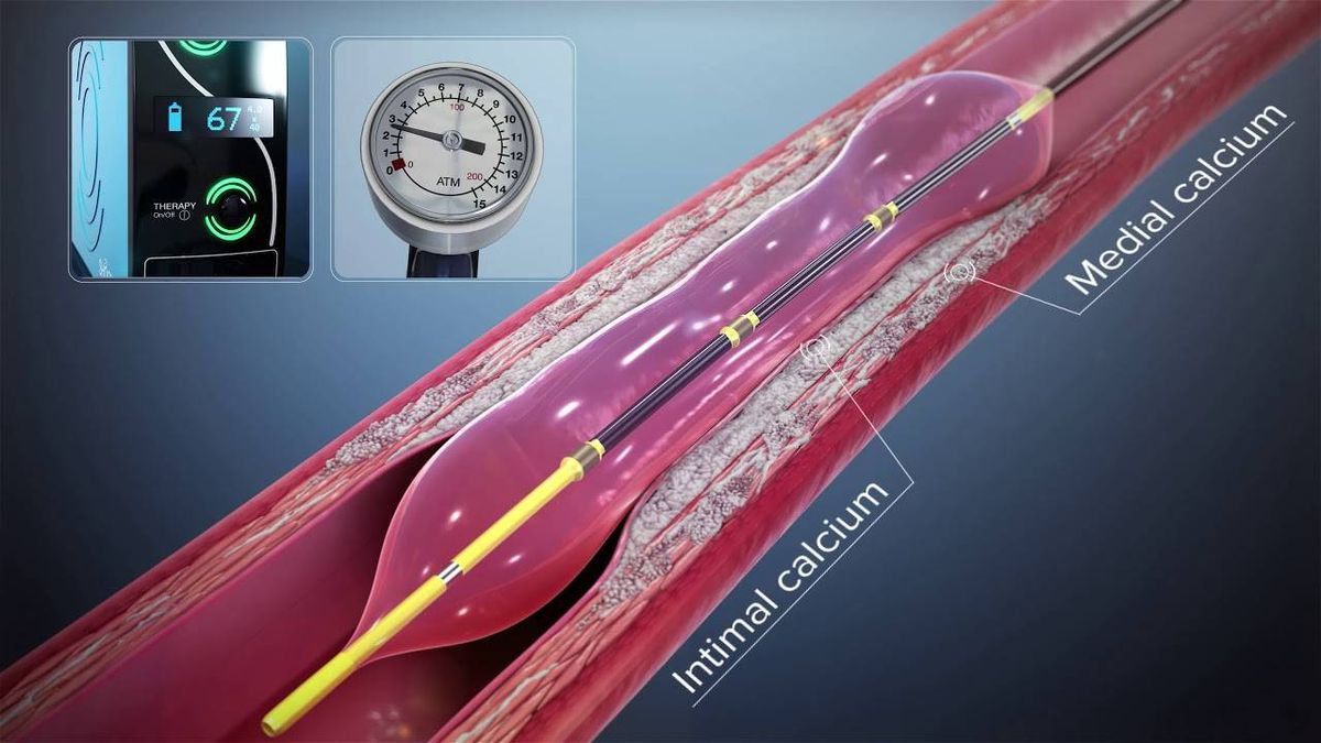 New procedure safely clears calcium blockages in heart with sonic waves