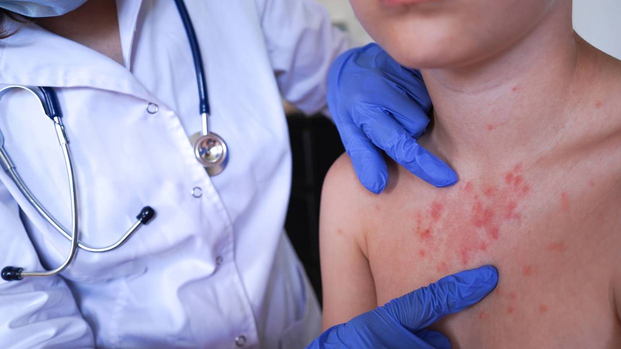 Health officials warn of possible measles exposure at PHL on Fourth of July