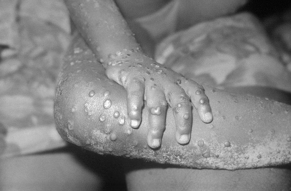 In this 1971 Center For Disease Control handout photo, monkeypox-like lesions are shown on the arm and leg of a female child in Bondua, Liberia.