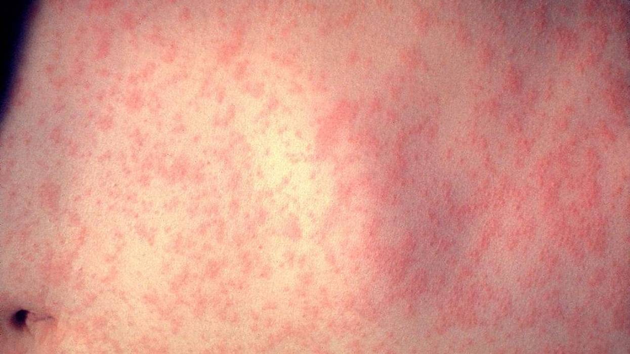 In this handout from the Centers for Disease Control and Prevention (CDC), the skin of a patient after three days of measles infection is seen at a New York hospital in 1958.