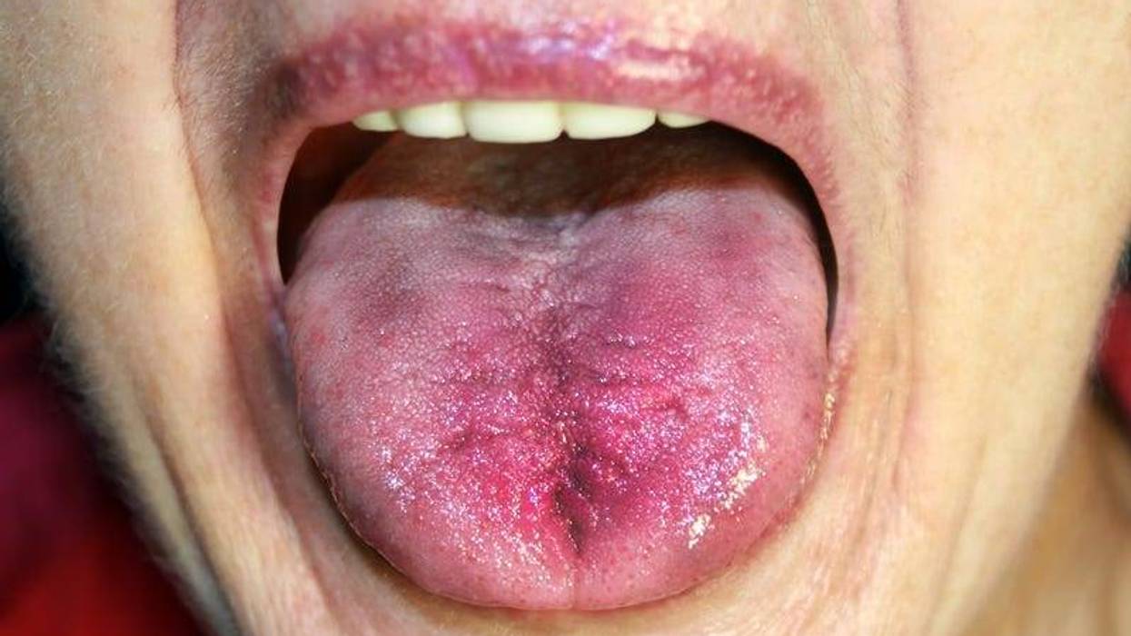 Inflamed tongue