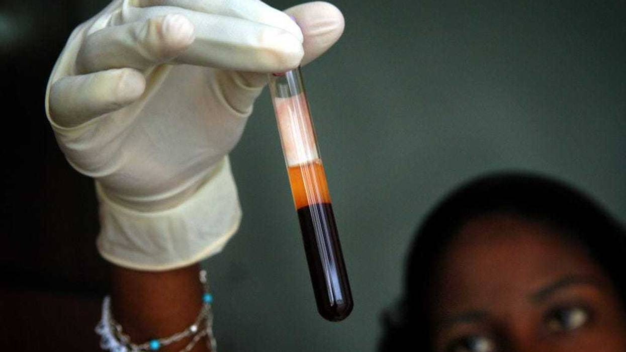 Jean Louis looks at a blood sample March 24, 2005 before it will tested at the lab of Zanmi Lasante Hospital in Cange, Haiti.