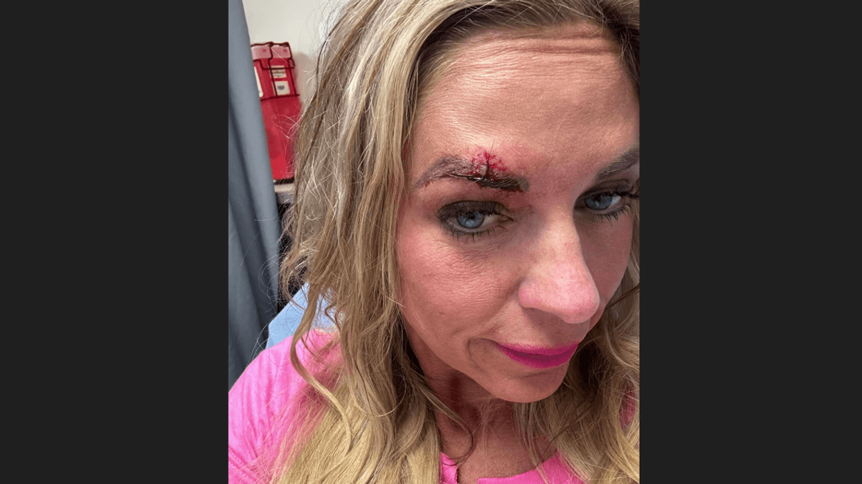 Jen Mascaro with stitches after attack at Steelers game in Las Vegas
