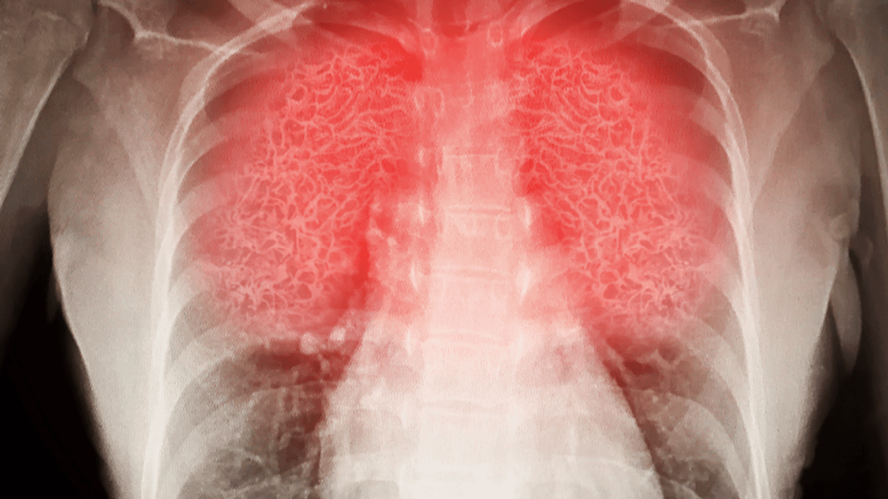 lungs x-ray image