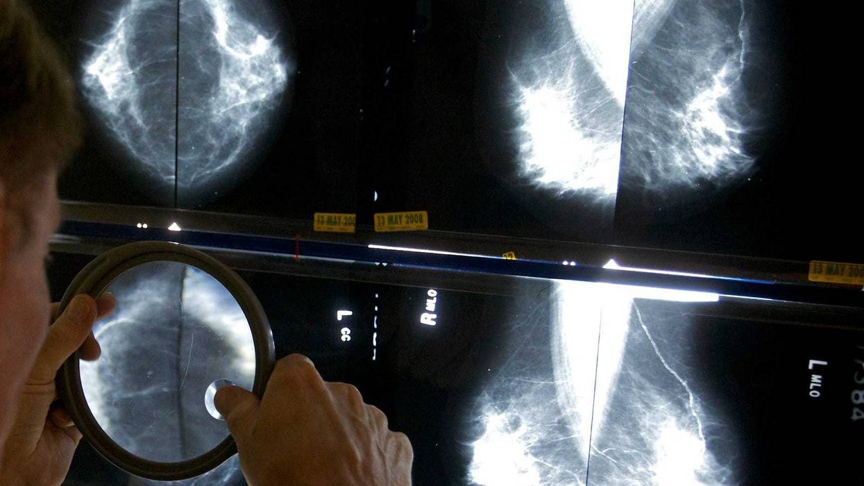 Mammograms-Explainer