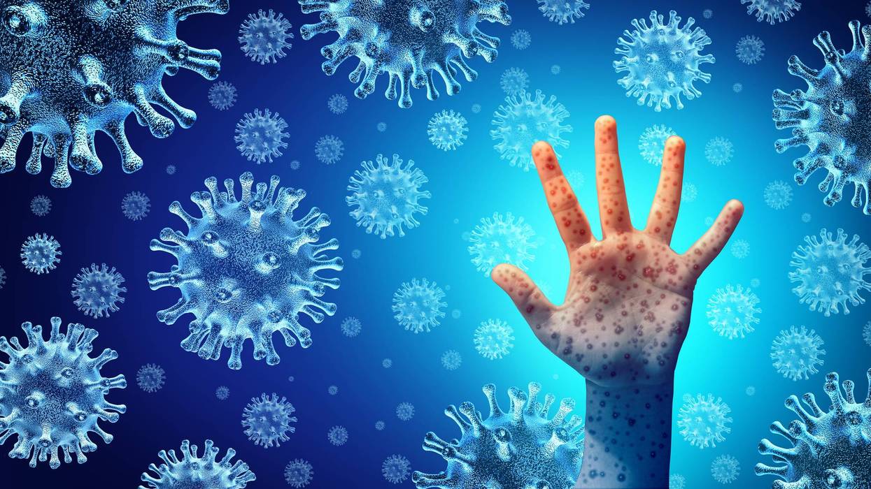 Measles Disease Outbreak